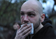 Избитый активист Игорь Ясин. Фото Л.Барковой/Грани.Ру
