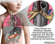 Фото с сайта health.allrefer.com/health/cystic-fibrosis-cystic-fibrosis.html